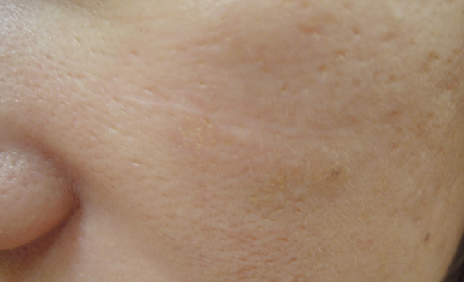 Лазерное удаление рубца после процедуры