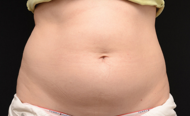 CoolSculpting-живот до процедуры