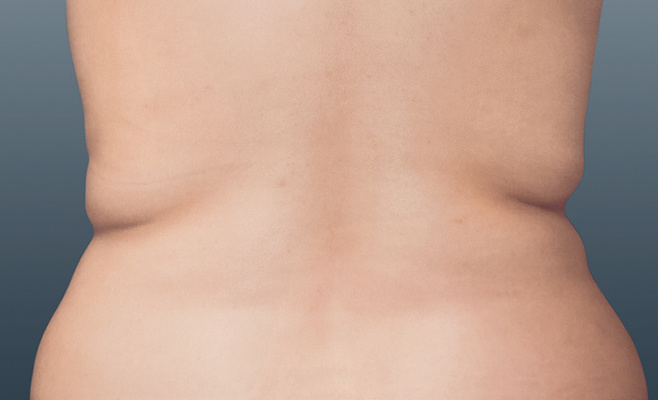 CoolSculpting-тело до процедуры