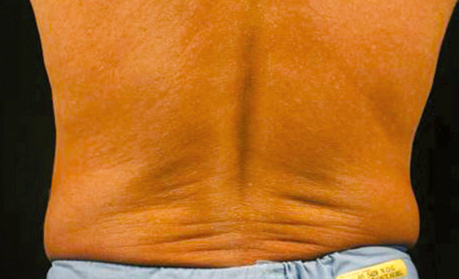 CoolSculpting-тело до процедуры