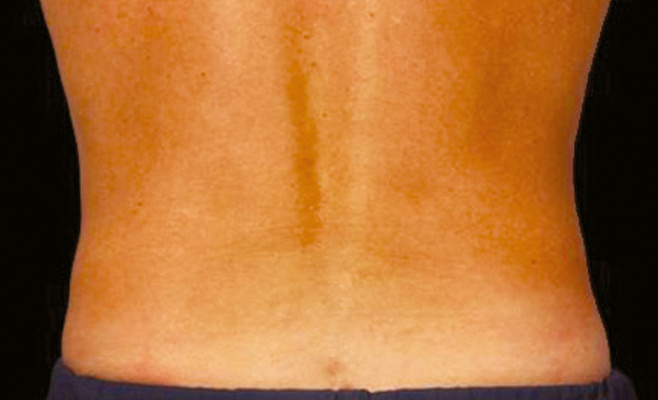 CoolSculpting-тело после процедуры