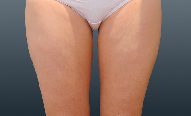 CoolSculpting-ноги после процедуры